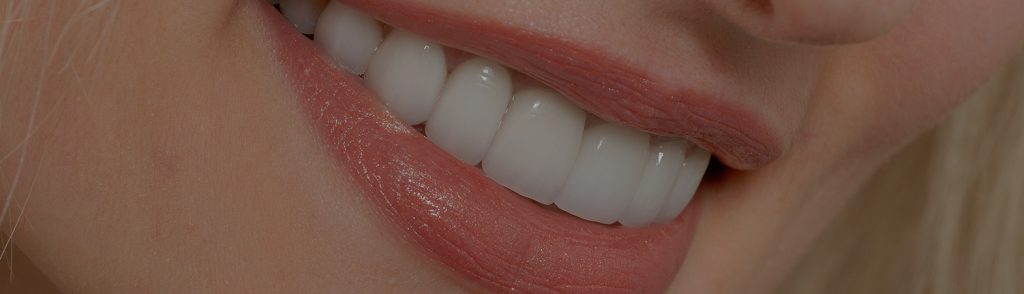 feat-veneers