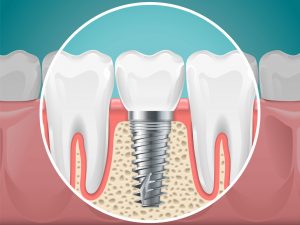 dental implants at Galliano Family Dentistry