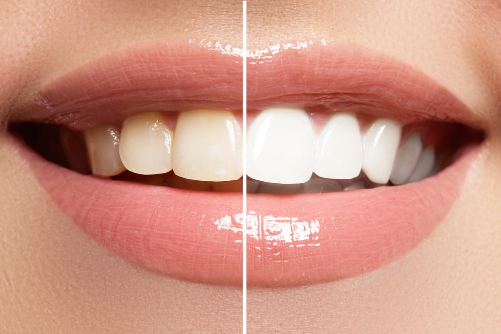 Is Professional Teeth Whitening Worth It? Absolutely!