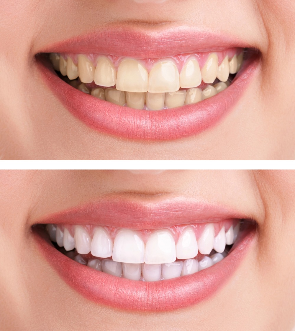 Professional Teeth Whitening: Understanding The Process