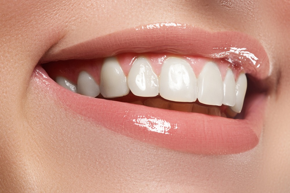 Veneers Vs. Teeth Whitening: Which Is Right For You?